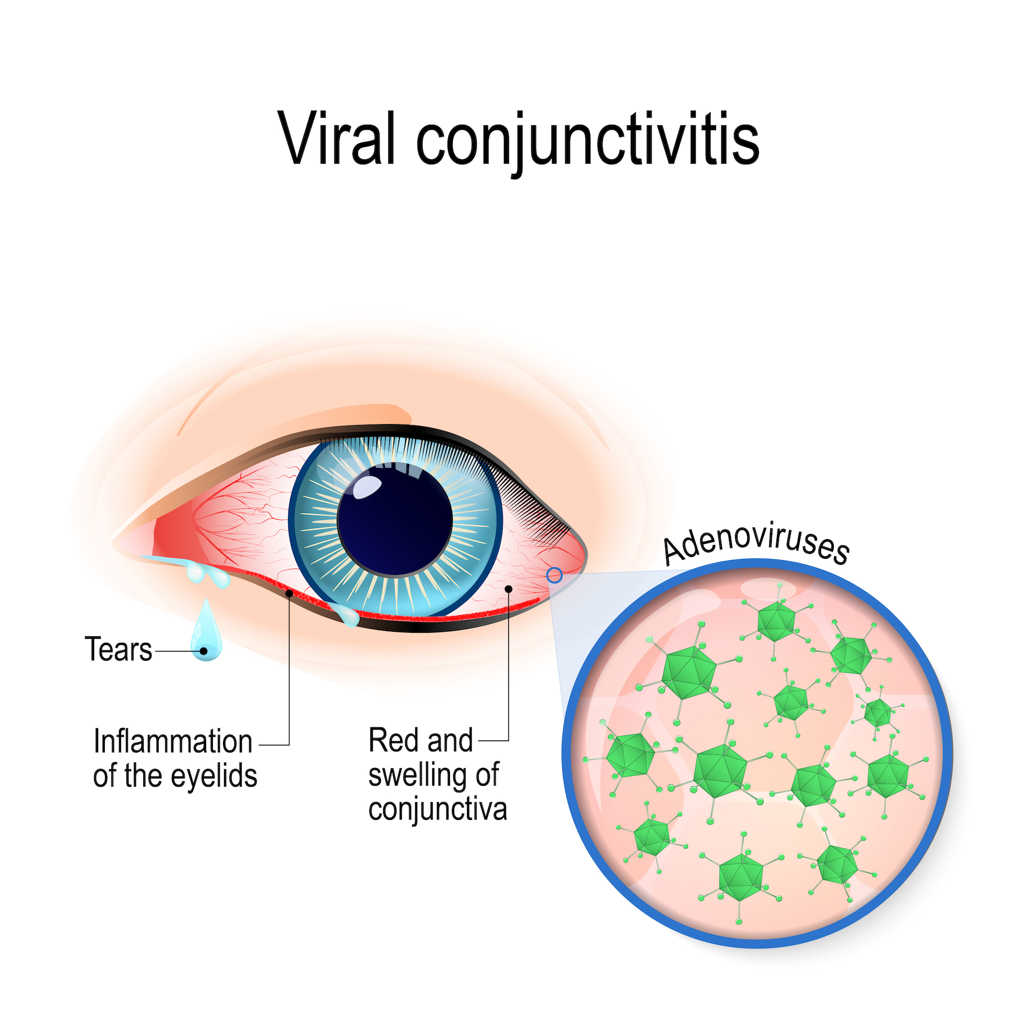 AdV Conjunctivitis